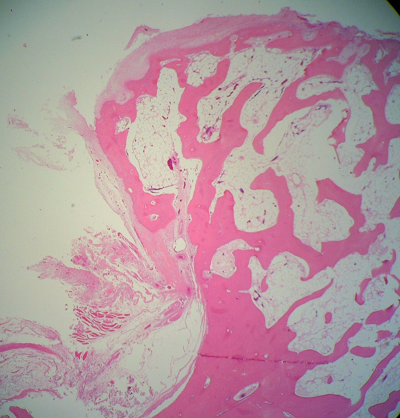 Figure 6. Osteochondroma - hyaline cartilage cap overlying trabecular bone (endochondral-ossification interface, H&E). Sarahkayb, CC BY-SA 4.0, Wikimedia Commons.