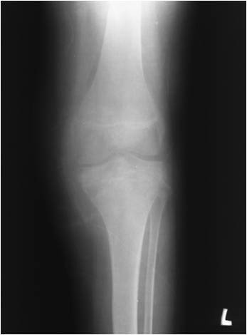 Figure 9. Chondroblastoma - eccentric osteolytic epiphyseal lesion of the proximal tibia. Kundu et al., J Orthop Surg Res 2010, CC BY, via PMC.