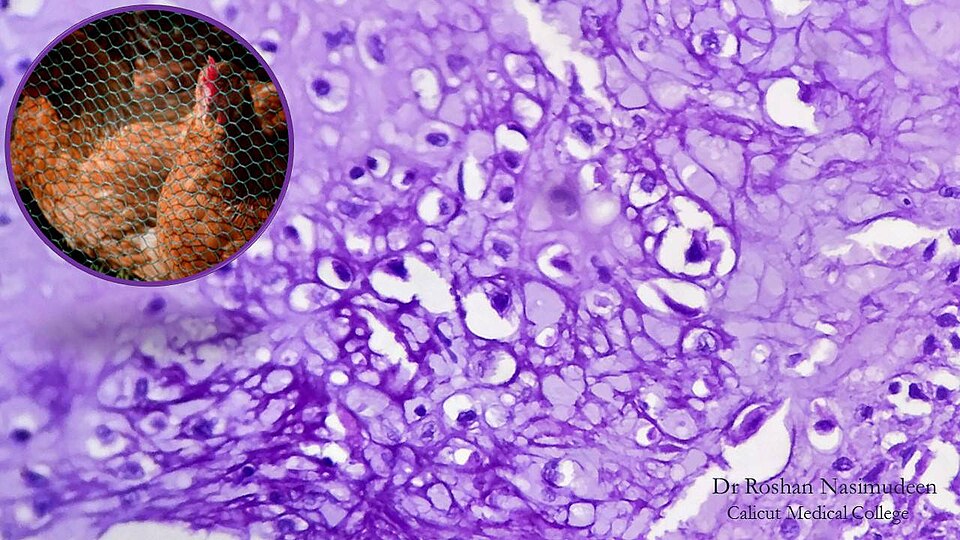 Figure 10. Chondroblastoma - chondroblasts with “chicken-wire” pericellular calcification (H&E). R. Nasimudeen, CC BY-SA 4.0, Wikimedia Commons.
