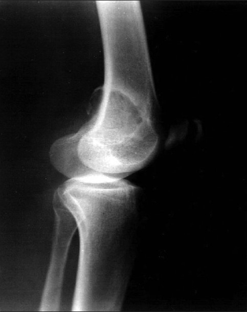 Figure 11. Chondromyxoid fibroma - eccentric, expansile lytic lesion with a sclerotic rim (distal femur). Kumar et al., J Cytol 2010, CC BY, via PMC.