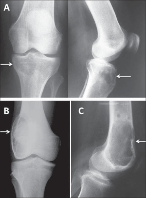 Figure 12. Giant cell tumour - eccentric, purely lytic lesion extending to subchondral bone about the knee. Costa et al., Radiol Bras 2016, CC BY, via PMC.