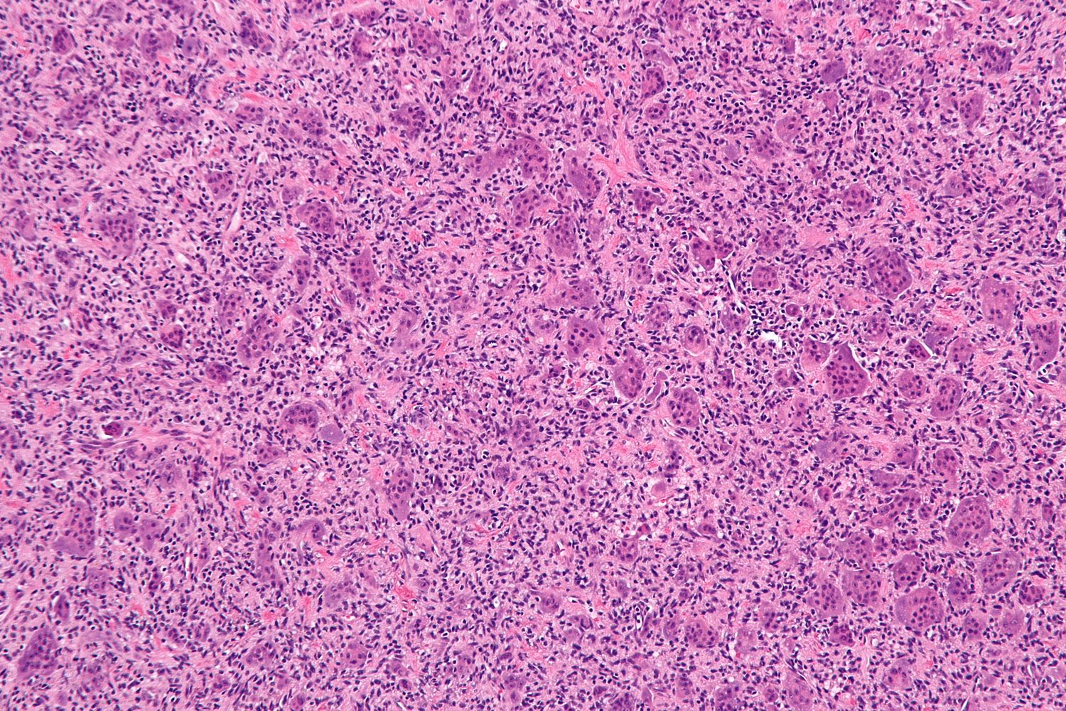 Figure 13. Giant cell tumour - osteoclast-type giant cells evenly distributed among mononuclear stromal cells whose nuclei they match (H&E). Nephron, CC BY-SA 3.0, Wikimedia Commons.