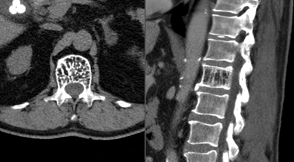 Figure 14. Vertebral haemangioma - axial “polka-dot” and sagittal “corduroy” coarse vertical trabeculae (CT). Hellerhoff, CC BY-SA 3.0, Wikimedia Commons.