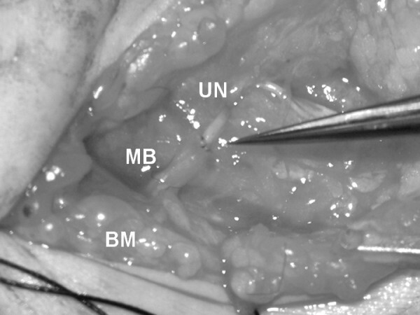 Figure 6. Intra-operative Oberlin nerve transfer: a fascicle of the ulnar nerve (on the forceps) is coapted to the motor branch (MB) of the biceps muscle (BM) to restore elbow flexion. Credit: From Shigematsu et al. (2006), J Brachial Plex Peripher Nerve Inj, PMC1636634, Fig. 2, CC BY 2.0.