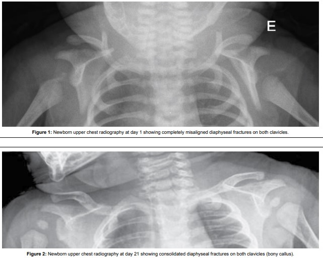 Figure 7. Neonatal chest radiographs of bilateral diaphyseal clavicle fractures from shoulder dystocia: day 1 (displaced) and day 21 (consolidating with abundant callus). Credit: From Oliveira et al., Clinical Medical Reviews and Case Reports 3:119, via Wikimedia Commons, CC BY 4.0.