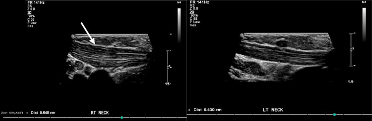 Figure 10. Ultrasound of fibromatosis colli: fusiform hypertrophy of the right sternocleidomastoid (arrow) compared with the normal left muscle. Credit: From Aljahdali et al. (2023), Cureus, PMC10657154, Fig. 1, CC BY 4.0.