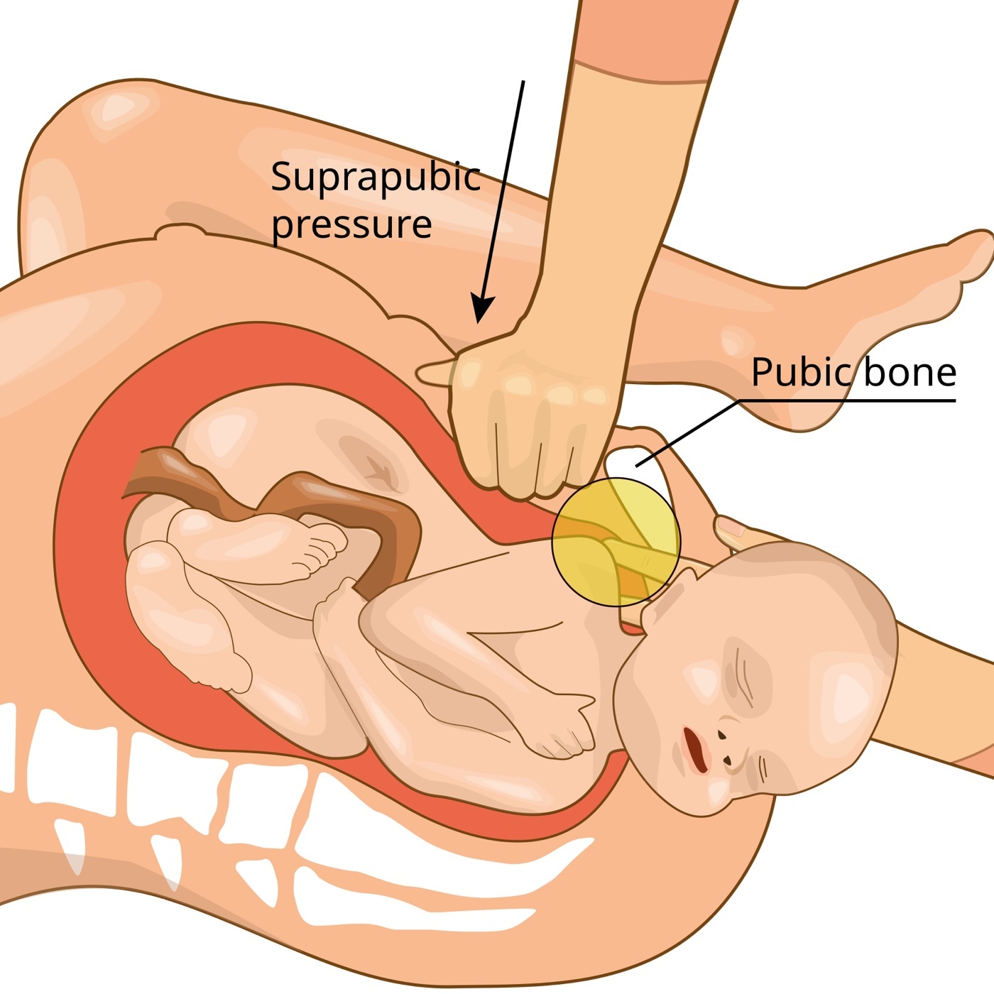 Figure 1. Mechanism of shoulder dystocia: the fetal anterior shoulder is impacted behind the maternal pubic symphysis. Suprapubic pressure (a first-line manoeuvre) is shown; excessive lateral traction on the head in this situation is what overstretches the upper brachial plexus and may fracture the clavicle. Credit: Hariadhi, via Wikimedia Commons, CC BY-SA 4.0.