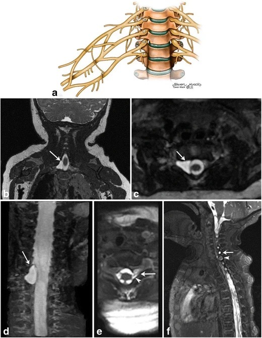 Figure 3. Brachial plexus MRI (with an explanatory diagram, panel a) demonstrating a right-sided traumatic pseudomeningocele at the C8-T1 level (arrows), the radiological marker of root avulsion. Credit: From Chaturvedi et al., Insights into Imaging 9 (2018), illustration by Gwendolyn Mack, via Wikimedia Commons, CC BY 4.0.