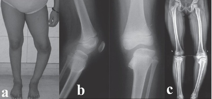 Infantile Blount’s disease (Langenskiöld IV). Clinical varus of the leg (a), with lateral and antero-posterior knee radiographs (b) showing medial metaphyseal beaking and depression of the medial tibial epiphysis, and a long-leg alignment film (c) with medial mechanical-axis deviation. Umrani SP, Aroojis AJ, Indian J Orthop 2008;42(3):351-354, Fig. 1 (CC BY).