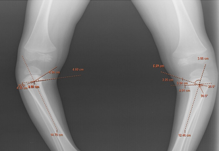 The metaphyseal-diaphyseal (Levine-Drennan) angle. Weight-bearing radiograph of both proximal tibiae with the angle constructed and measured (here ~21° and ~26°), confirming bilateral tibia vara. Vagha K et al., Pan Afr Med J 2022;42:161, Fig. 2 (CC BY 4.0).