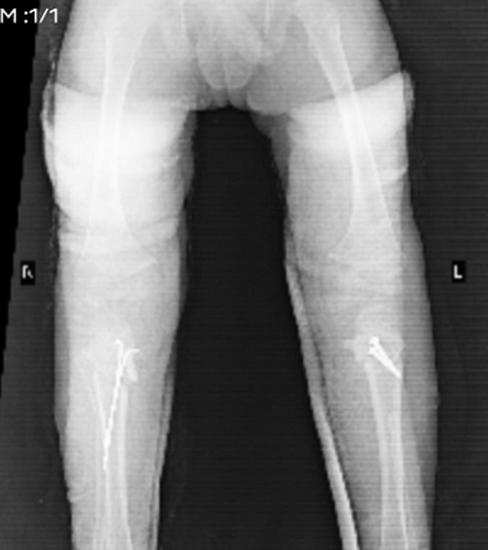 Corrective osteotomy. Post-operative radiograph after proximal tibial osteotomy with internal fixation, the bowing corrected. Vagha K et al., Pan Afr Med J 2022;42:161, Fig. 4 (CC BY 4.0).