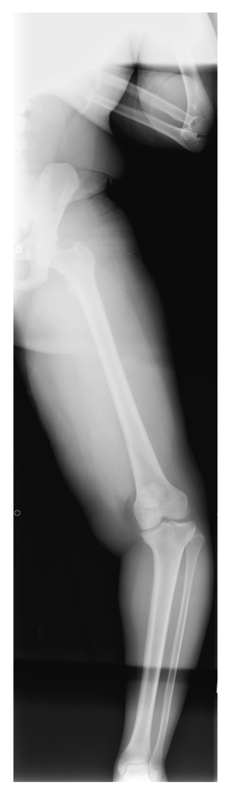 Adolescent (late-onset) Blount’s disease. Full-limb lateral radiograph of a heavy adolescent showing multilevel deformity (distal-femoral and proximal-tibial varus). Robbins CA, Children (Basel) 2021;8(7):566, Fig. 22 (CC BY 4.0).