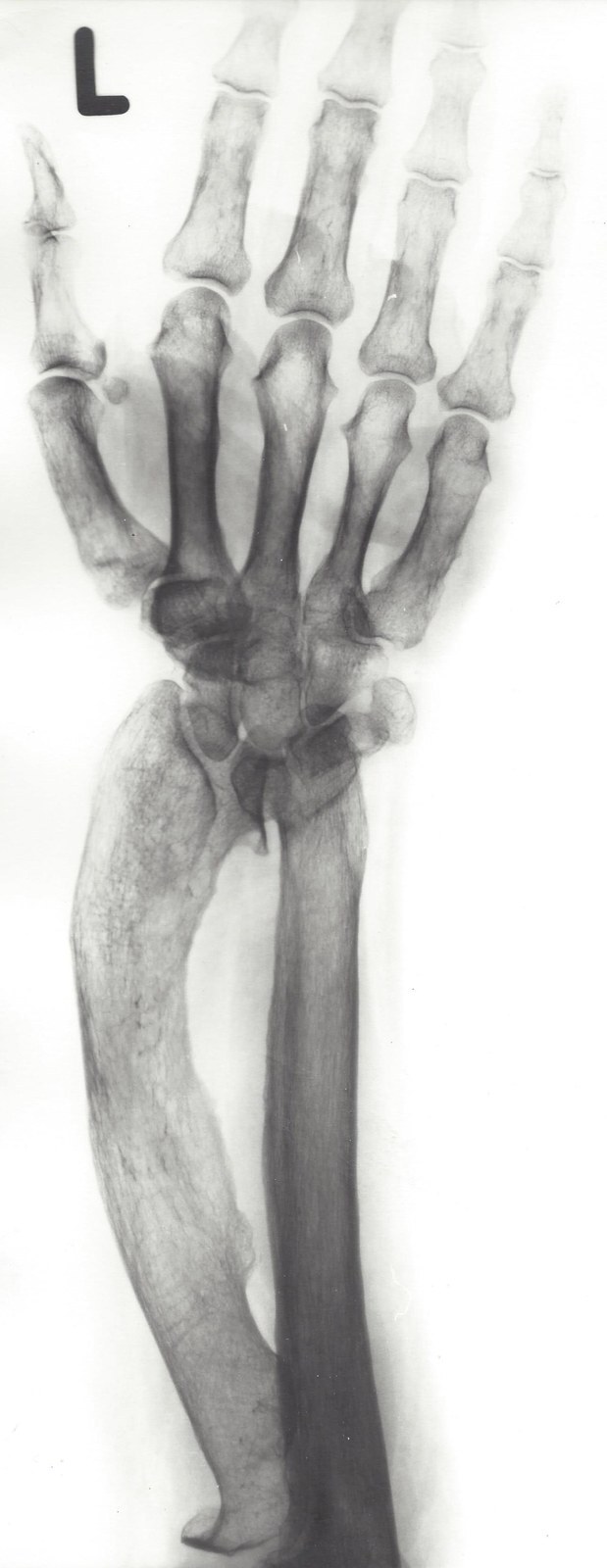 Madelung deformity (PA forearm radiograph). Marked bowing and shortening of the radius, a prominent distal ulna and proximal carpal subsidence (the lunate driven into the radioulnar gap). Röntgeninstitut des Städtischen Krankenhauses Kiel, Wikimedia Commons (CC BY-SA 3.0).