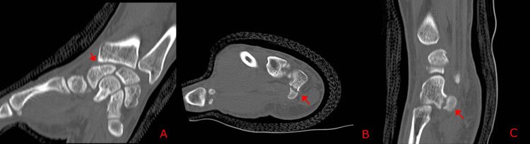 Figure 11. Nonunion of the hook of the hamate on CT (axial, coronal, and sagittal panels). Mannan & Kent, Cureus 2026, CC BY 4.0.