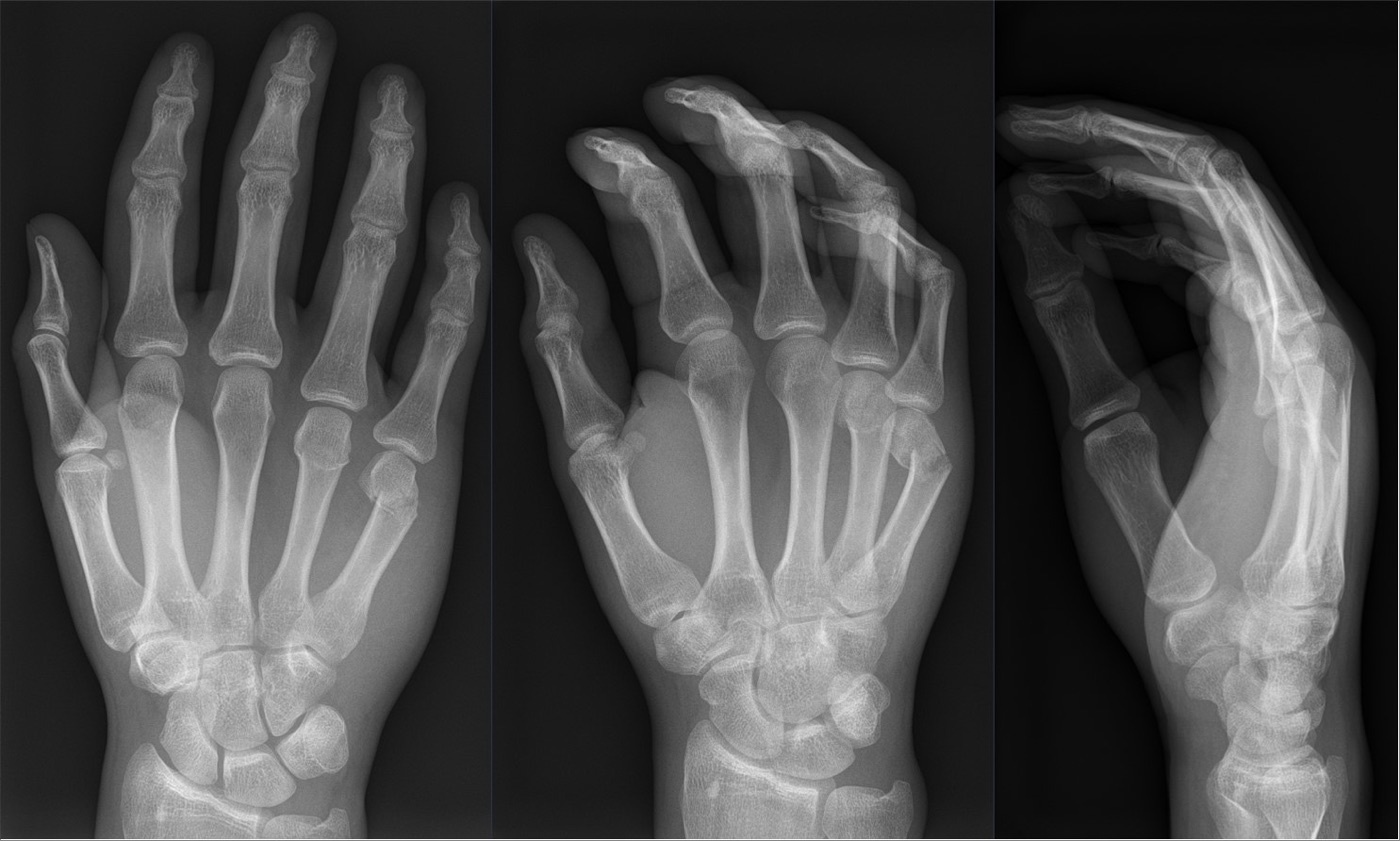 Figure 12. A boxer’s fracture: the little-finger metacarpal neck with apex-dorsal angulation, three views. Hellerhoff, CC BY-SA 4.0, via Wikimedia Commons.