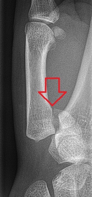 Figure 14. A Bennett fracture: the intra-articular fracture-dislocation of the thumb metacarpal base (arrow). Hellerhoff, CC BY-SA 3.0, via Wikimedia Commons.