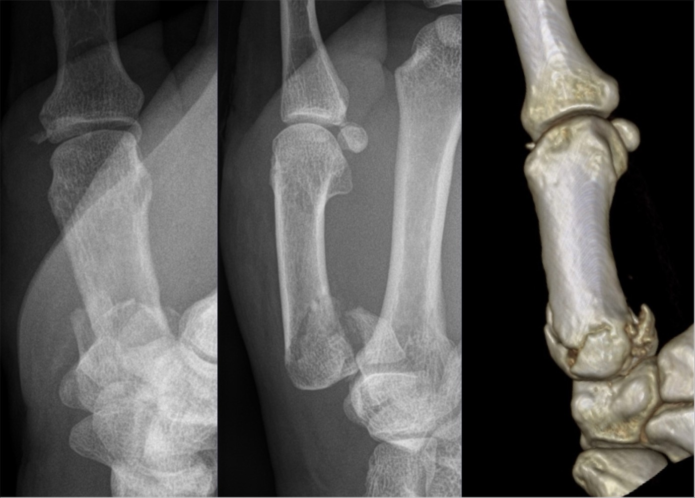 Figure 15. A Rolando fracture: the comminuted Y/T-shaped intra-articular fracture of the thumb metacarpal base, radiographs and 3D CT. Hellerhoff, CC BY-SA 4.0, via Wikimedia Commons.