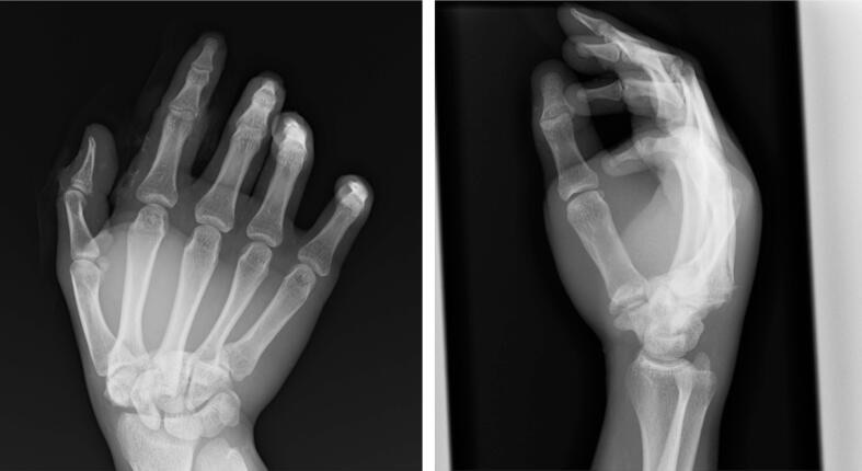 Figure 16. Dorsal carpometacarpal dislocation (3rd and 4th CMC joints), PA and lateral radiographs. Mogi et al., Trauma Case Reports 2026, CC BY 4.0.