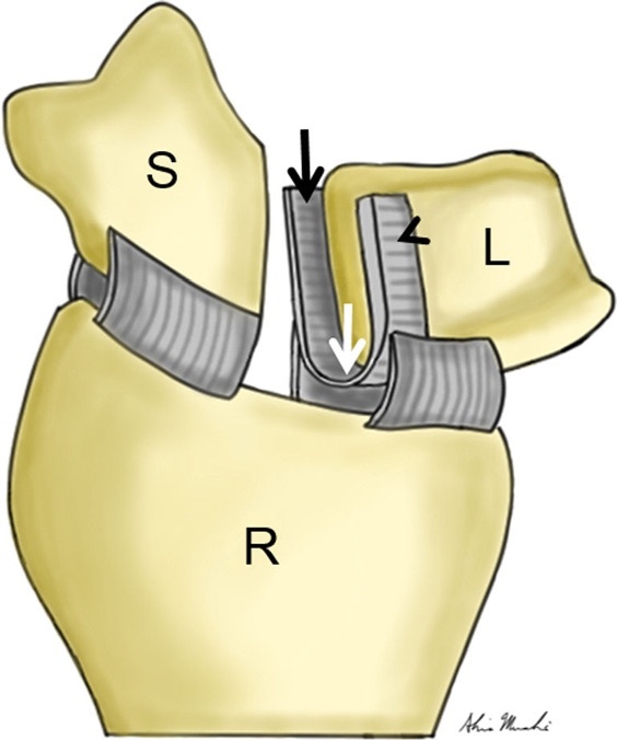 Figure 3. The scapholunate interosseous ligament between the scaphoid (S) and lunate (L) on the radius (R), the primary stabiliser of the scapholunate joint. Tischler et al., CC BY 4.0, via Wikimedia Commons.