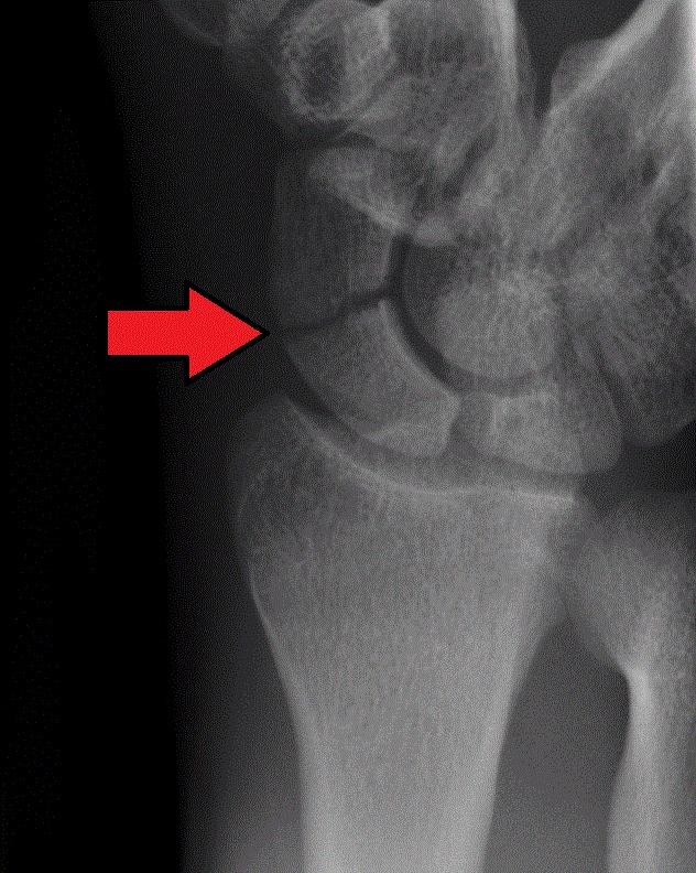 Figure 5. A scaphoid waist fracture on the PA wrist radiograph (arrow). Gilo1969, CC BY-SA 3.0, via Wikimedia Commons.