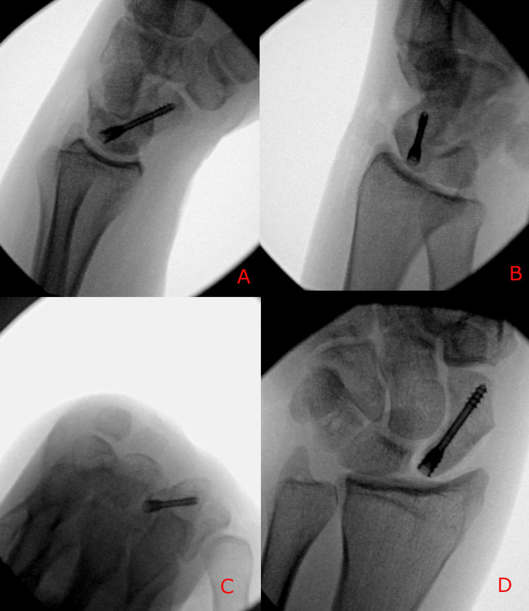 Figure 6. A scaphoid fracture fixed with a headless compression screw (intra-operative fluoroscopy). Mannan & Kent, Cureus 2026, CC BY 4.0.