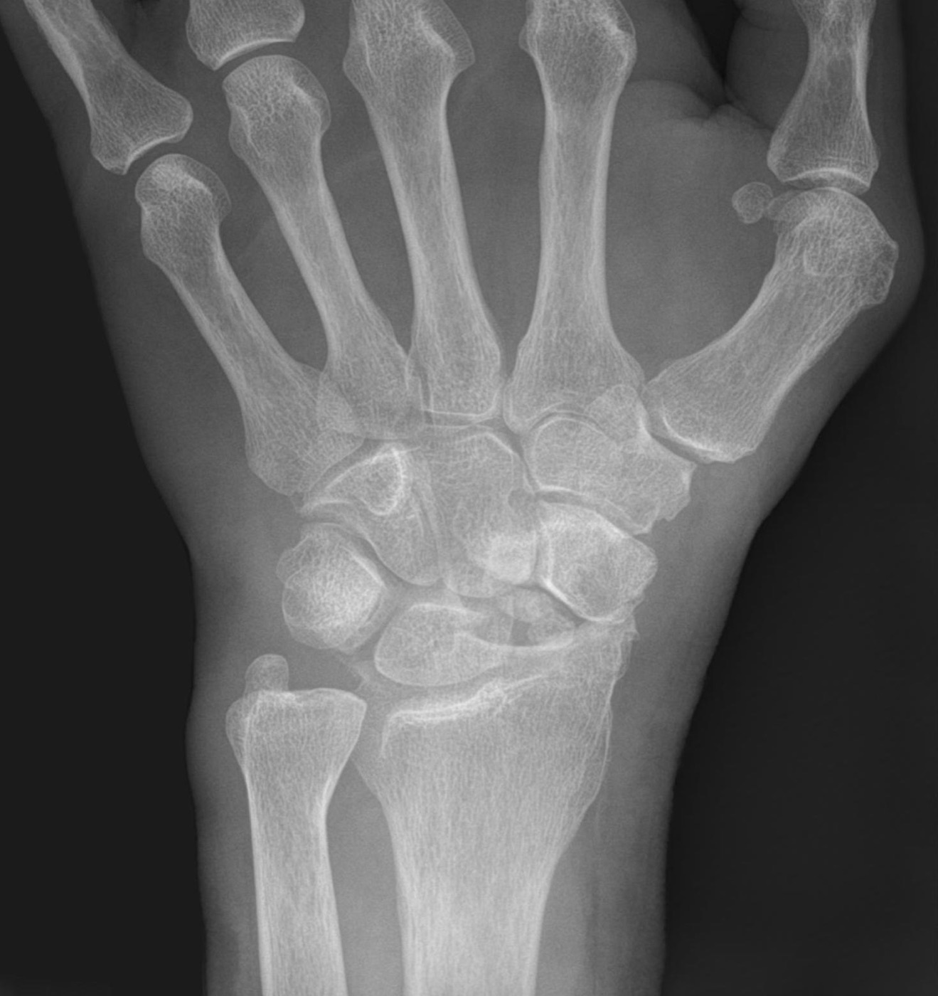 Figure 7. Scaphoid nonunion with advanced collapse (SNAC) on the PA radiograph. Hellerhoff, CC BY-SA 4.0, via Wikimedia Commons.