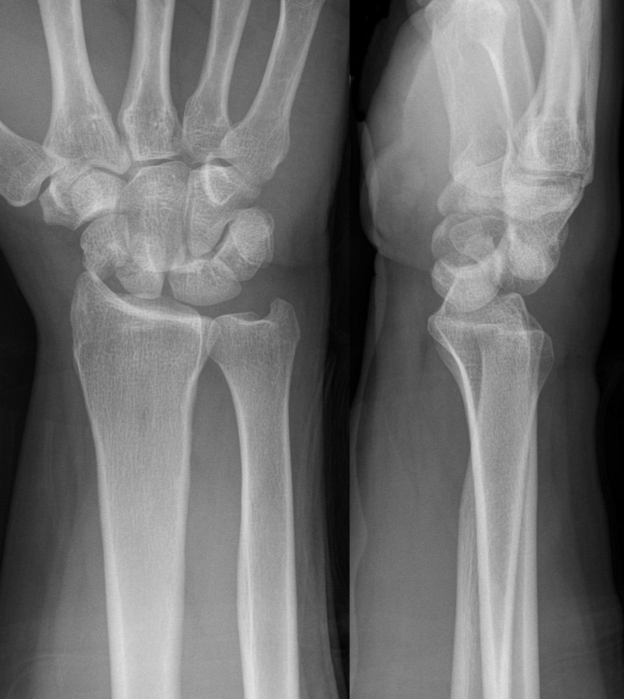 Figure 8. A trans-scaphoid perilunate fracture-dislocation, PA and lateral radiographs, the commonest greater-arc injury. Hellerhoff, CC BY-SA 3.0, via Wikimedia Commons.