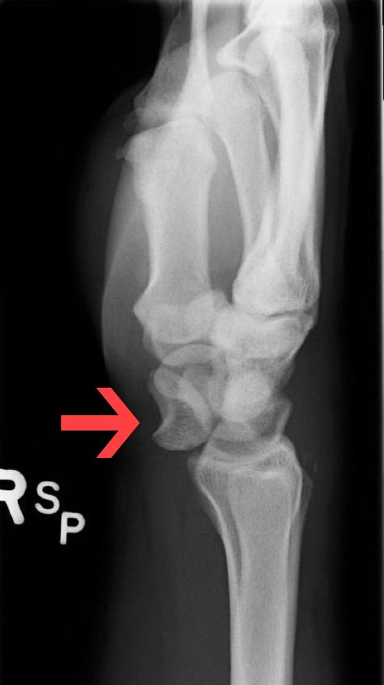 Figure 9. Lunate dislocation on the lateral radiograph: the lunate is tipped volarly (the “spilled teacup”), the end stage of the Mayfield sequence. James Heilman, MD, CC BY-SA 3.0, via Wikimedia Commons.