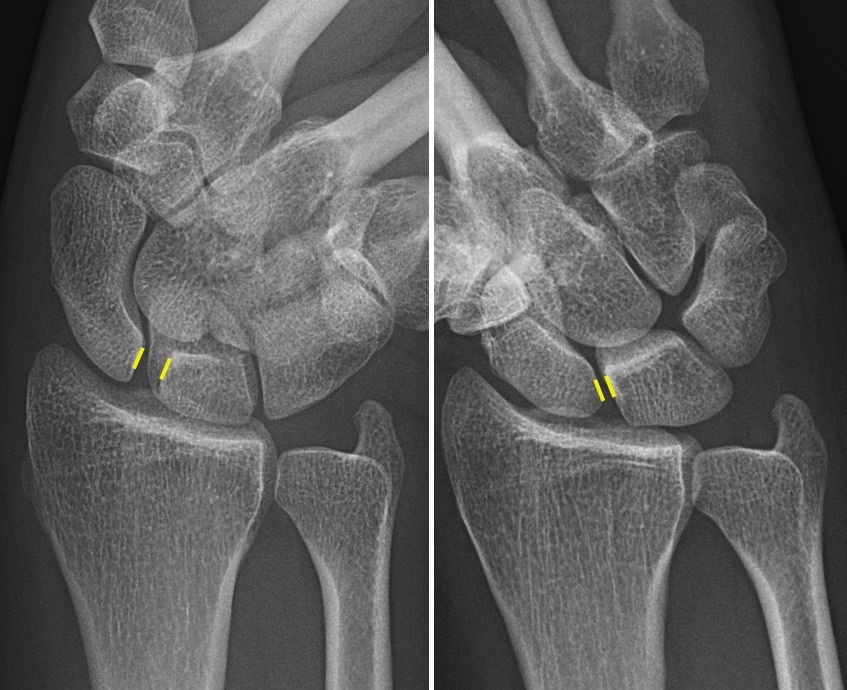Figure 10. Scapholunate dissociation: a widened scapholunate interval (the Terry-Thomas sign), annotated radiographs. Mikael Häggström, CC0, via Wikimedia Commons.