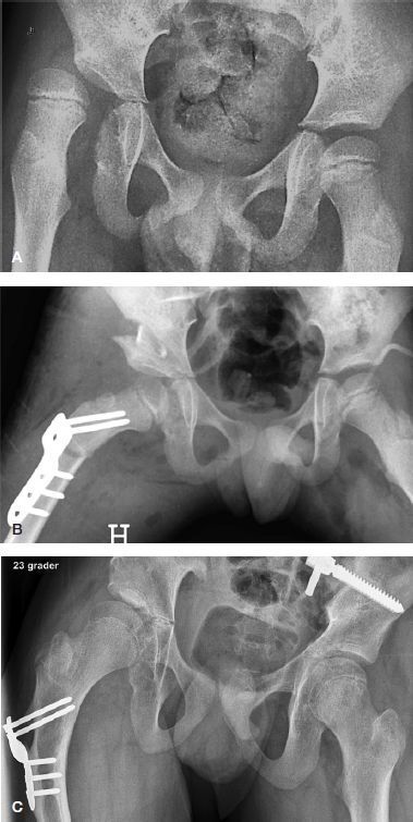 Reconstruction of the spastic hip. Antero-posterior pelvis of a child (GMFCS V) with right-hip subluxation (MP 67%): (A) pre-operative; (B) after a femoral varus-derotation-shortening osteotomy (blade plate) with pelvic osteotomy and soft-tissue release; (C) follow-up with maintained coverage. From Terjesen, Acta Orthop 2019;90:614-621 (CC BY 4.0).