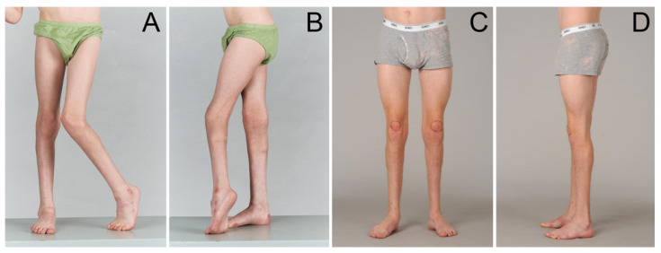 Spastic equinus. Standing clinical photographs (waist-down) of a boy with bilateral spastic CP: (A, B) pre-operative toe-walking equinus with knee recurvatum; (C, D) plantigrade feet after gastrocsoleus lengthening as part of single-event multilevel surgery. From Ma et al., Medicina (Kaunas) 2021;57:98 (CC BY 4.0).