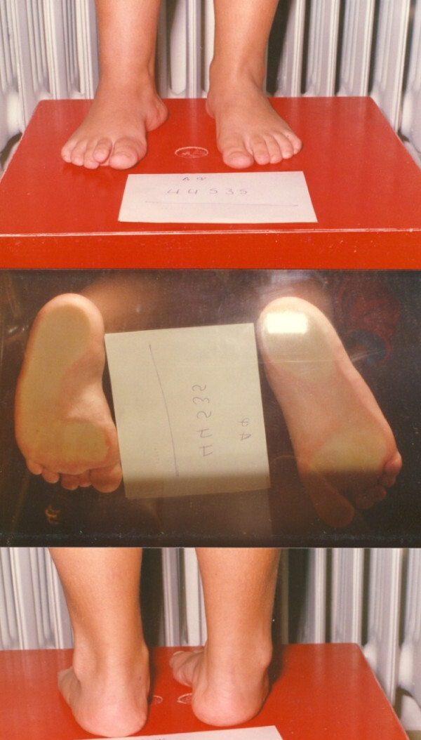 Clinical assessment of the spastic varus foot. Standing dorsal view (top), a podoscope view of the soles through glass (middle) and a posterior heel view (bottom) in a child with spastic equinovarus. From Vlachou & Dimitriadis, J Foot Ankle Res 2010;3:28 (CC BY 2.0).