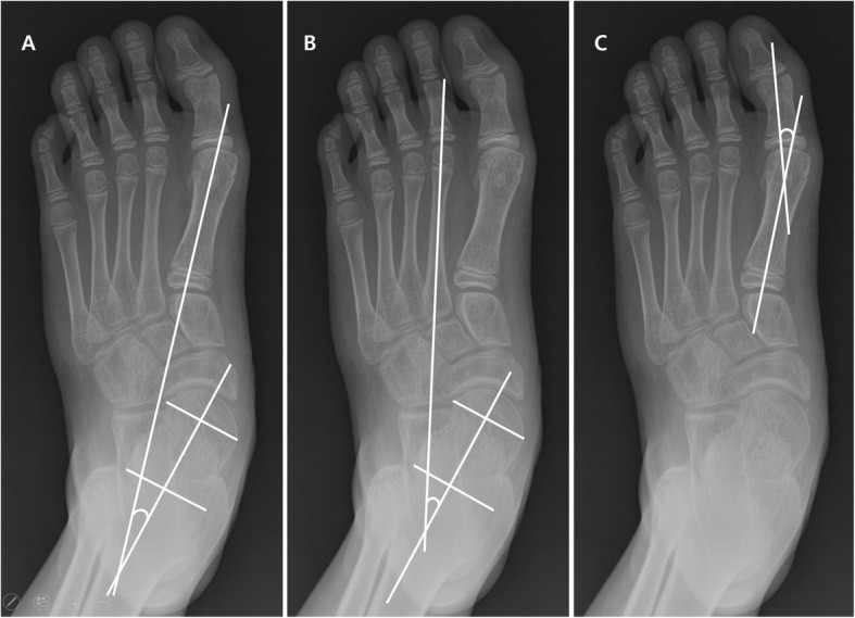 Planovalgus deformity - radiographic assessment. Antero-posterior foot radiographs with the talo-first-metatarsal, talo-second-metatarsal and hallux-valgus angles drawn to grade the planovalgus deformity of cerebral palsy. From Min et al., BMC Musculoskelet Disord 2020;21:141 (CC BY 4.0).