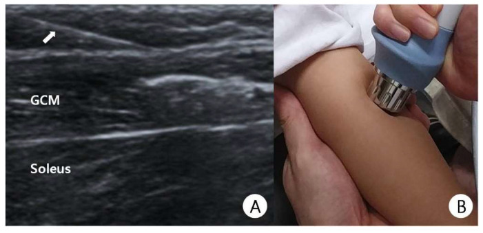 Botulinum toxin A injection. (A) Ultrasound of the calf during a sonography-guided injection of the medial gastrocnemius (GCM; soleus below, needle at the arrow); (B) the same child receiving adjunctive shock-wave therapy. From Kwon & Kwon, Children (Basel) 2021;8:1059 (CC BY 4.0).