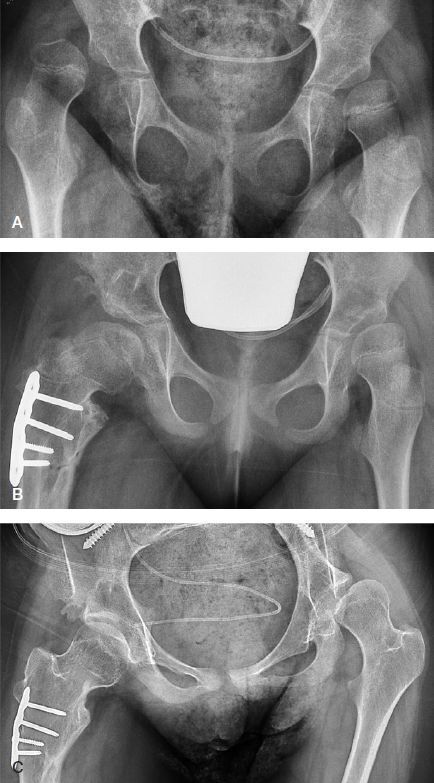 Spastic hip disease. Antero-posterior pelvic series of a non-ambulant child (GMFCS V): (A) dislocation of the right hip with subluxation of the left; (B, C) after femoral and pelvic osteotomy of the right hip (blade plate) with soft-tissue release. From Terjesen, Acta Orthop 2019;90:614-621 (CC BY 4.0).