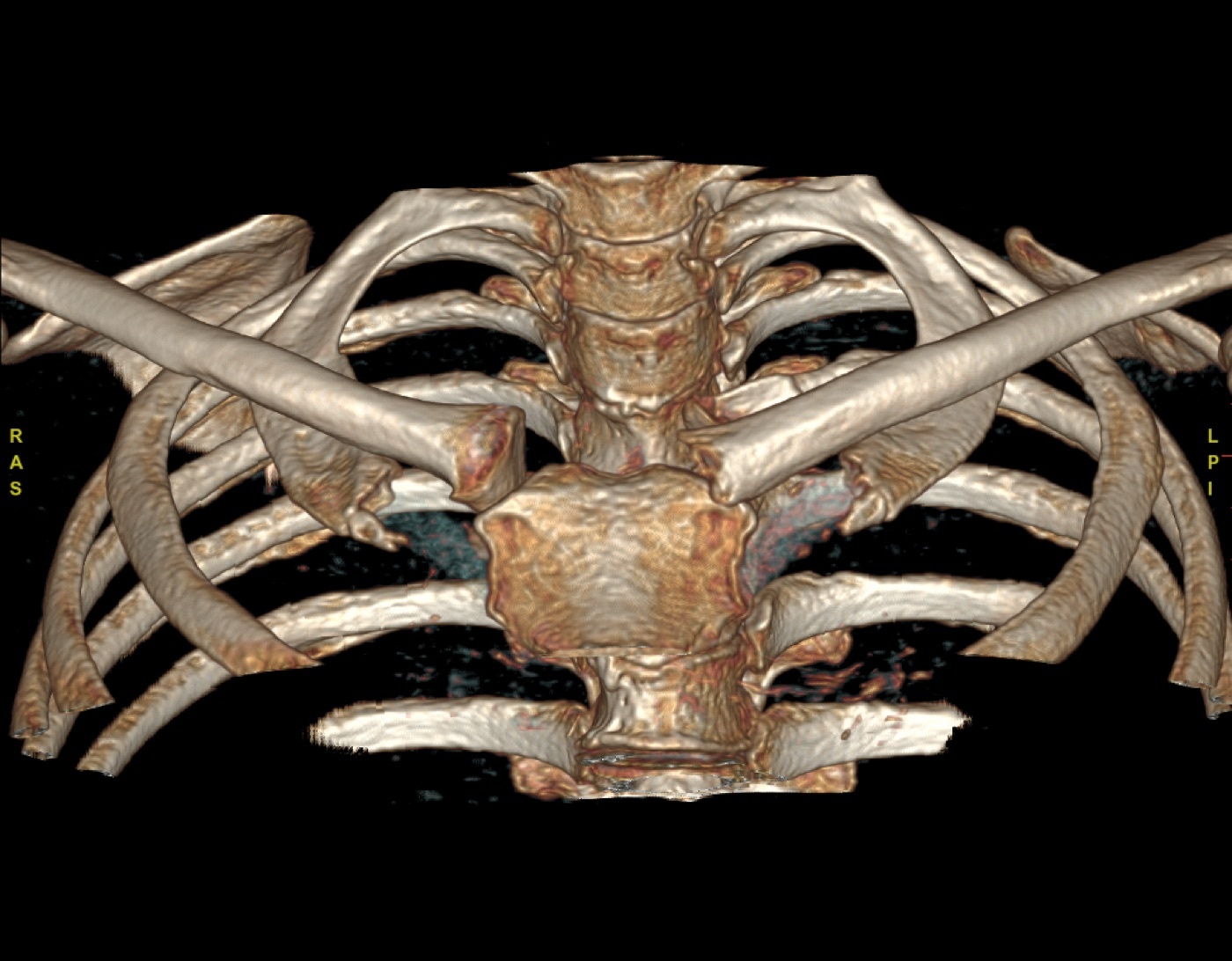 Figure 8. Left sternoclavicular fracture-dislocation on 3D CT, the imaging modality of choice for this joint. Source: Jmarchn, via Wikimedia Commons, CC BY-SA 3.0.