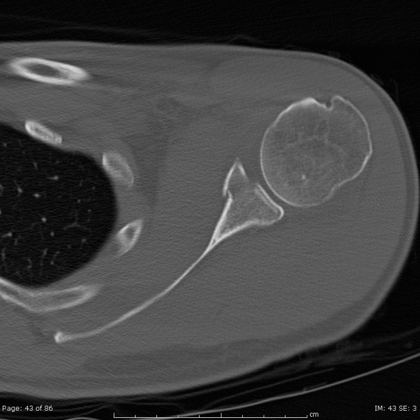 Figure 11. Intra-articular glenoid fracture on axial CT; an articular step or gap of about 4 to 5 mm with subluxation is the indication for fixation. Source: Drahreg01, via Wikimedia Commons, CC BY-SA 3.0.