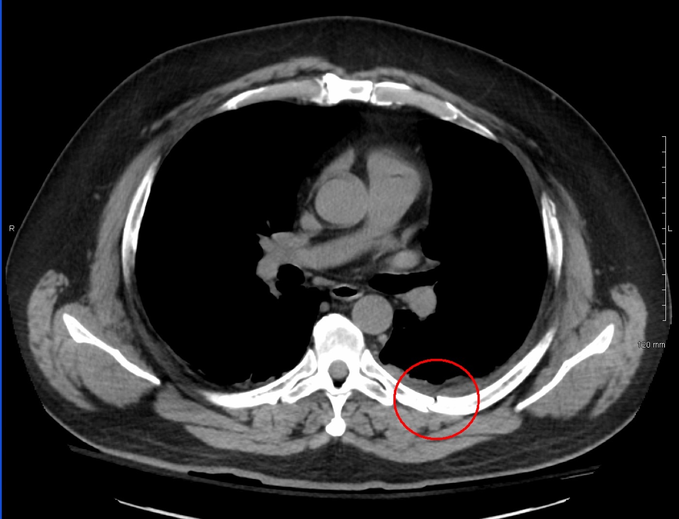 Figure 12. Rib fracture on axial chest CT (circled); CT is far more sensitive than plain films, which miss more than half of rib fractures. Source: James Heilman, MD, via Wikimedia Commons, CC BY-SA 3.0.