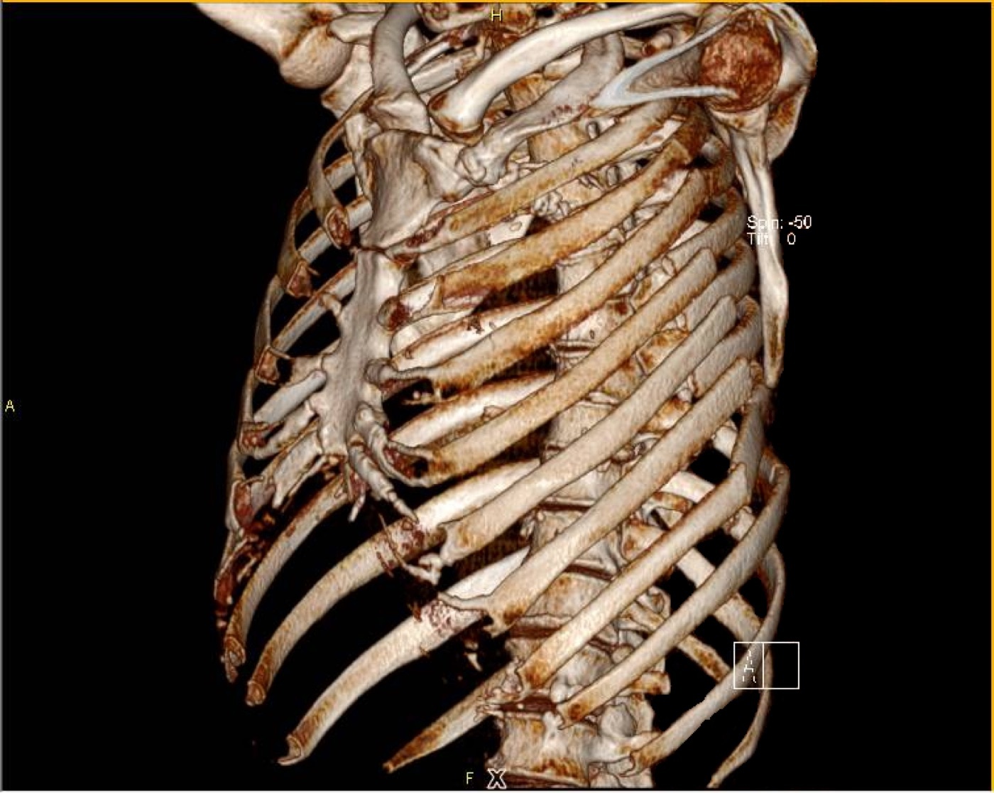 Figure 14. Serial (segmental) rib fractures on 3D CT, each rib broken in two places: the anatomical substrate of a flail segment. Source: Sjoehest, via Wikimedia Commons, CC BY-SA 3.0.