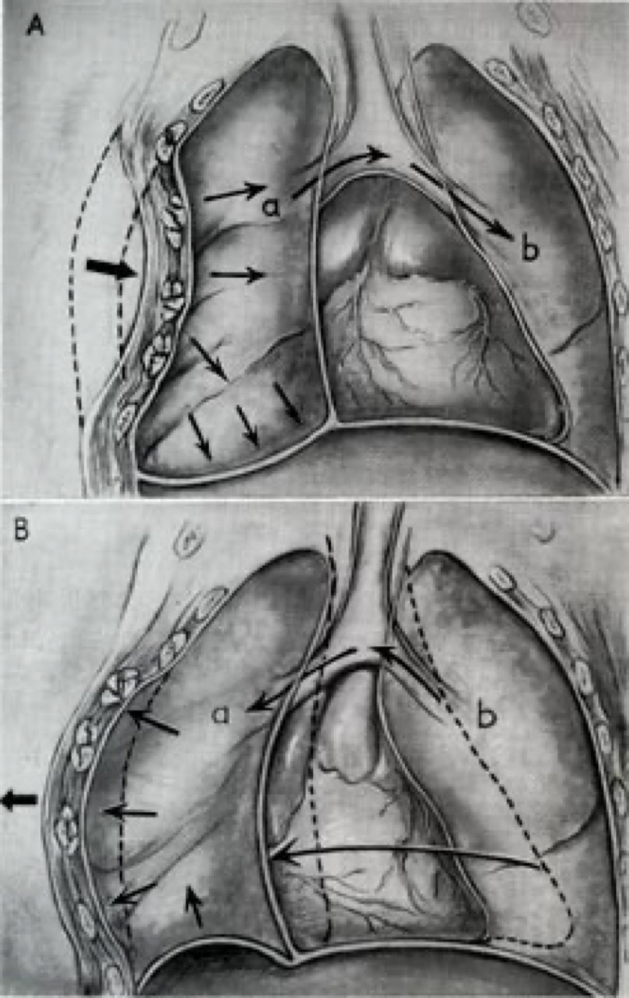 Figure 15. Paradoxical respiratory motion in flail chest (A inspiration, B expiration): the flail segment moves opposite to the rest of the chest wall. From Surgery in World War II: Thoracic Surgery (1965), U.S. Army, public domain, via Wikimedia Commons.