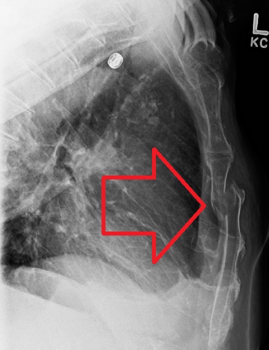 Figure 16. Displaced sternal fracture on the lateral radiograph (arrow). Source: James Heilman, MD, via Wikimedia Commons, CC BY-SA 4.0.