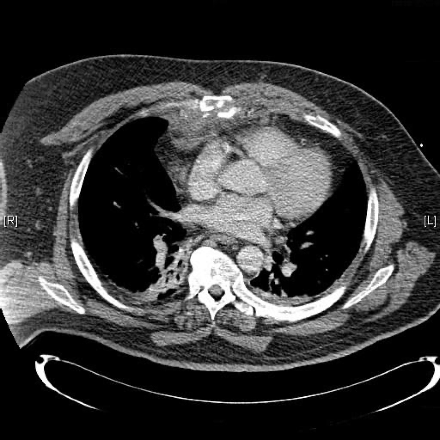 Figure 17. Sternal fracture on axial CT. From Monkhouse & Kelly, J Med Case Reports 2008;2:91, CC BY 2.0, via Wikimedia Commons.