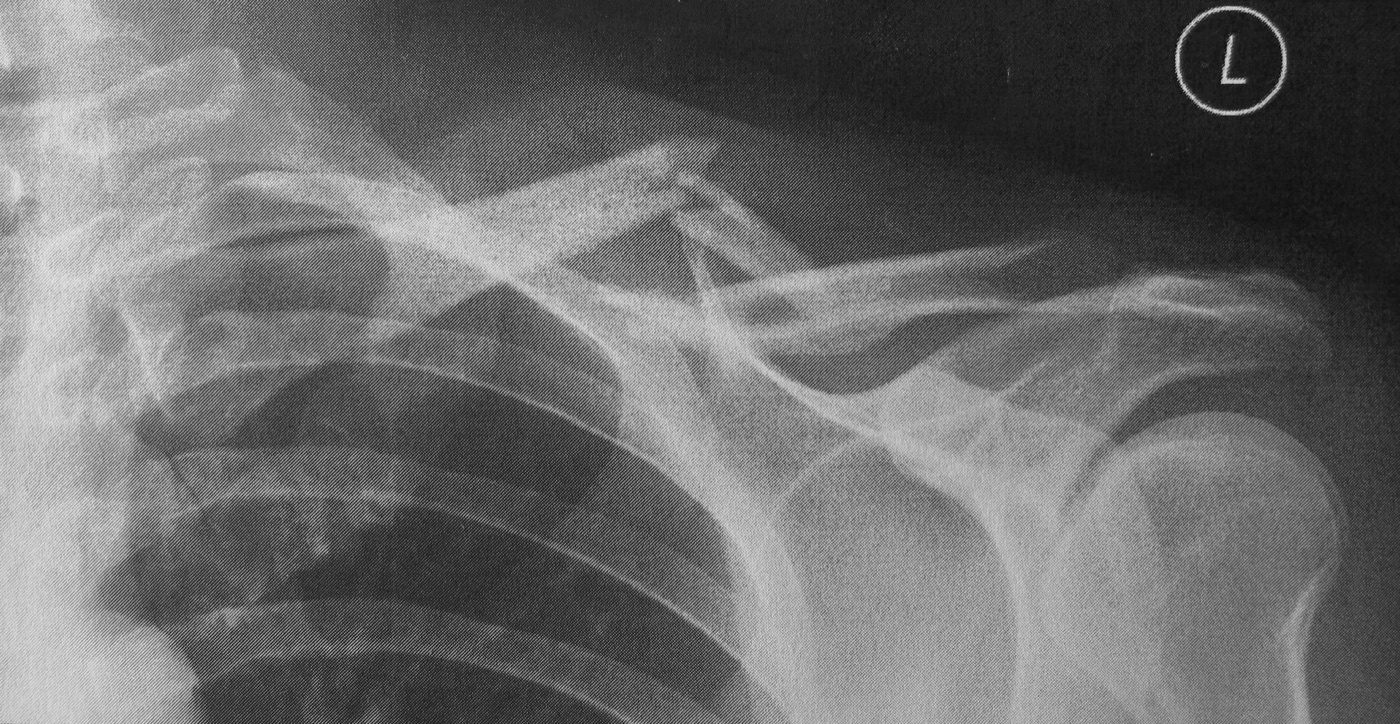 Figure 2. Displaced fracture of the middle third of the clavicle with overlap and shortening, the pattern for which primary plating reduces nonunion. Source: Ramessos, via Wikimedia Commons, CC BY-SA 3.0.