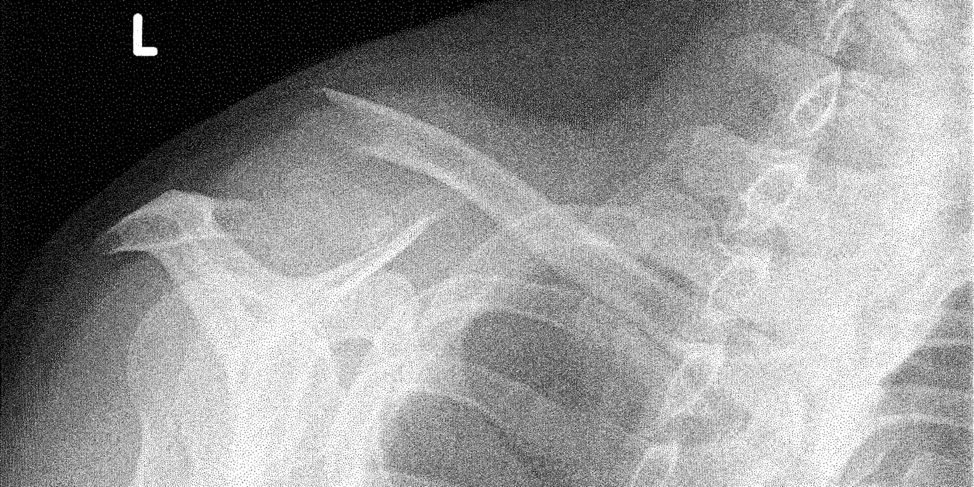 Figure 3. Fracture of the lateral (distal) third of the clavicle. Source: via Wikimedia Commons, CC BY-SA 3.0.