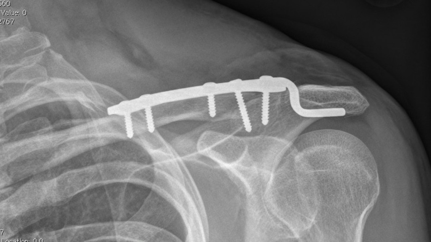 Figure 4. The same lateral clavicle fracture after open reduction and plate (hook-plate) fixation. Source: via Wikimedia Commons, CC BY-SA 3.0.