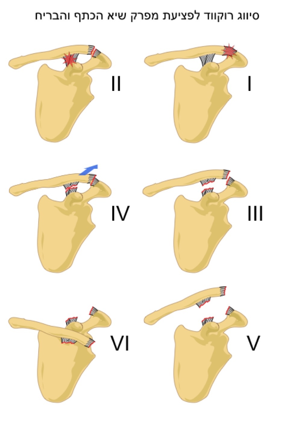 Figure 6. The Rockwood classification of acromioclavicular joint injuries, types I to VI. Source: Yosi I, via Wikimedia Commons, CC0.