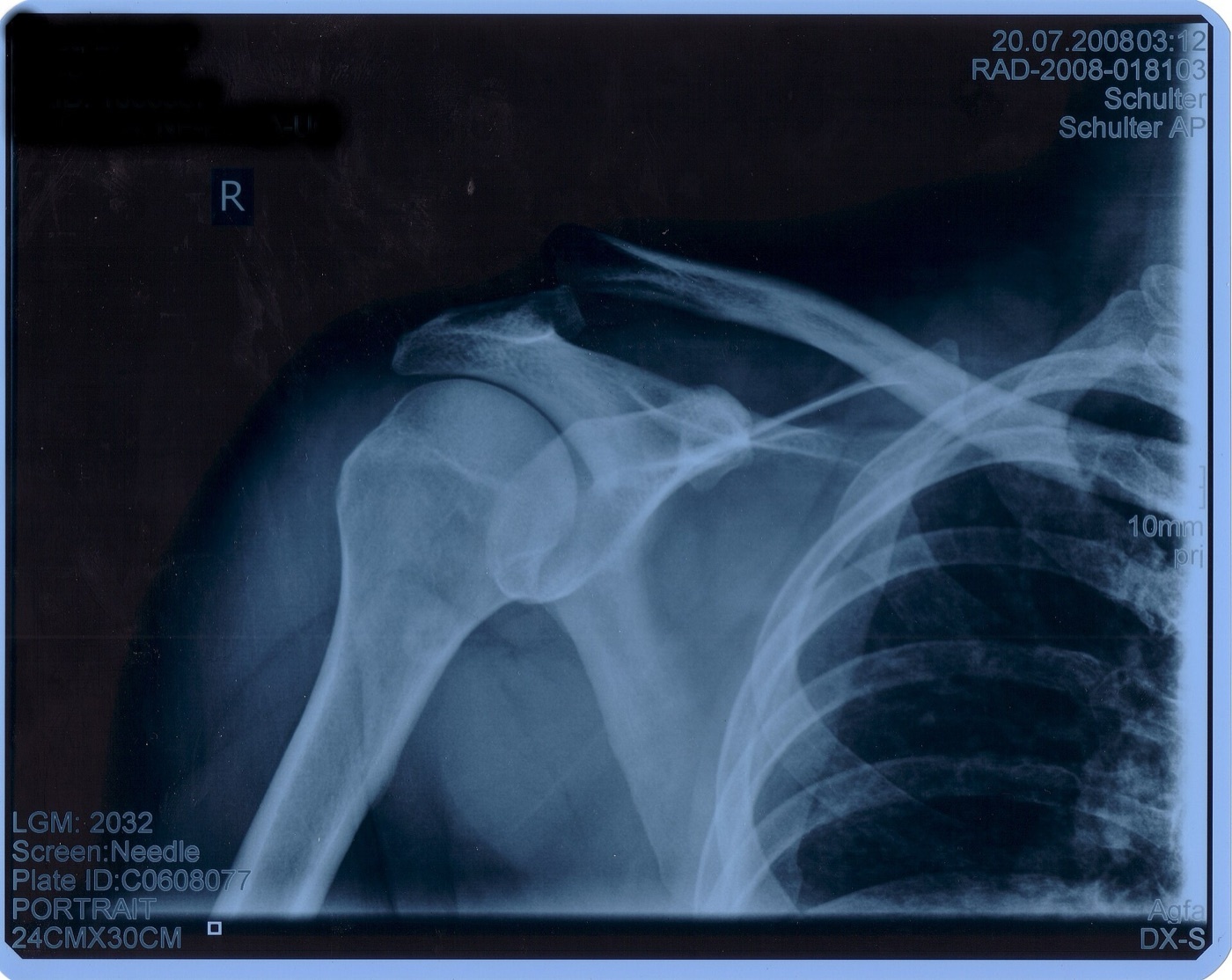 Figure 7. High-grade acromioclavicular dislocation (Tossy III / Rockwood V) with superior displacement of the distal clavicle. Source: St.-Elisabeth-Krankenhaus Dorsten, via Wikimedia Commons, public domain.