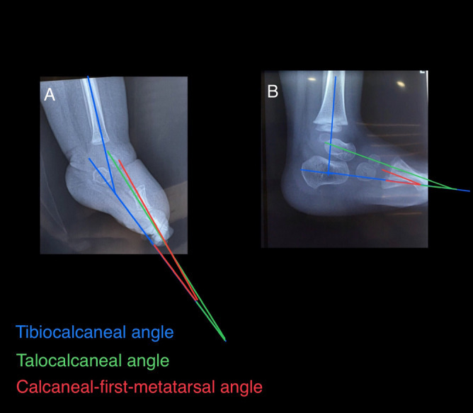 Lateral clubfoot radiographs before (A) and one year after (B) tendo-Achilles tenotomy, with the tibiocalcaneal, talocalcaneal and calcaneal-first-metatarsal angles labelled, showing correction of the hindfoot. (Tahririan et al., Sci Rep 2023;13:11734; CC BY 4.0.)