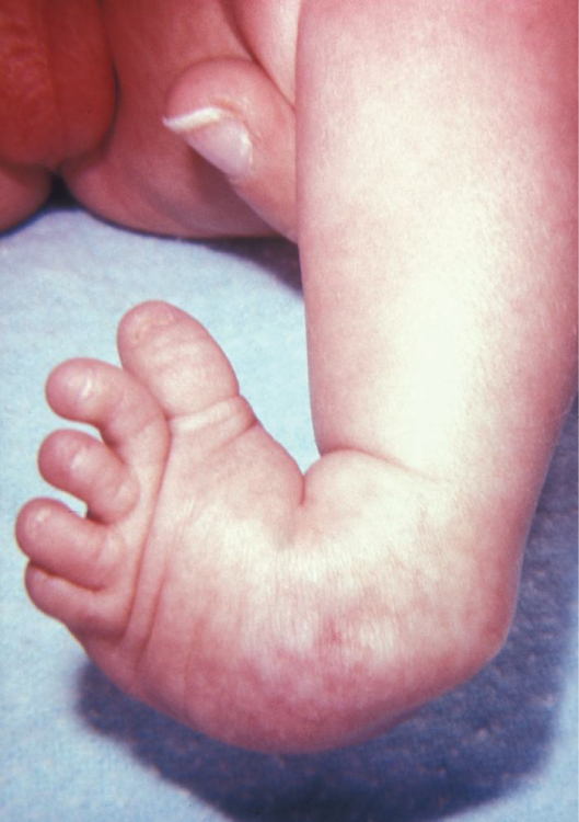 Clinical clubfoot in an infant: the foot is in equinus with hindfoot varus and forefoot adductus, the sole turned medially. (OpenStax College, Wikimedia Commons; CC BY 3.0.)