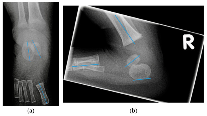Clubfoot radiographs in an infant - (a) antero-posterior and (b) lateral, with axis lines drawn for the talus, calcaneus and first metatarsal: the talocalcaneal (Kite) angle is reduced (parallelism) and the metatarsals are adducted. (Moerman et al., Children 2022;9:865; CC BY 4.0.)